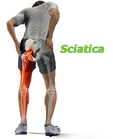 About Sciatica