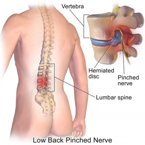 Herniated disc