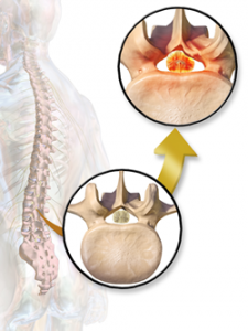 Thoracic Herniated Disc Surgery