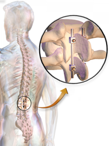 Spine Fusion Surgery