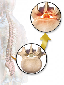 Stenosis