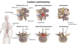 Lumbar Laminectomy