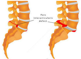 spondylolisthesis