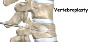 vertebroplasty