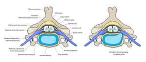 Minimally Invasive Discectomy